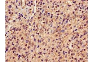 Immunohistochemistry of paraffin-embedded human glioma using ABIN7162945 at dilution of 1:100 (Peroxiredoxin 6 抗体  (AA 87-224))