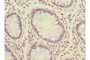 Immunohistochemistry of paraffin-embedded human colon cancer using ABIN7164721 at dilution of 1:100