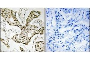 Immunohistochemistry analysis of paraffin-embedded human liver carcinoma tissue, using TOP2A Antibody. (Topoisomerase II alpha 抗体  (AA 1-50))
