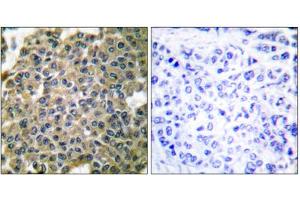 Immunohistochemical analysis of paraffin-embedded human breast carcinoma tissue using Keratin 7 antibody (ABIN5976442).