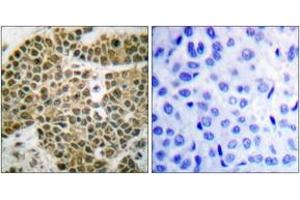 Immunohistochemistry analysis of paraffin-embedded human breast carcinoma tissue, using NF-kappaB p105/p50 (Ab-927) Antibody. (NFKB1 抗体  (AA 896-945))