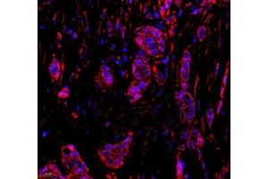 Immunofluorescence of paraffin embedded human breast cancer using DDX19B (ABIN7073694) at dilution of 1: 650 (400x lens) (DDX19B 抗体)