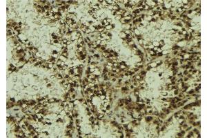 ABIN6278396 at 1/100 staining Human lung tissue by IHC-P. (RASSF2 抗体  (Internal Region))