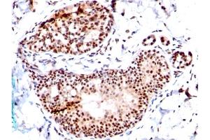 Formalin-fixed, paraffin-embedded human Breast Carcinoma stained with SUMO-1 Mouse Monoclonal Antibody (SM1/495) (SUMO1 抗体)