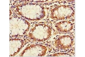 Immunohistochemistry of paraffin-embedded human colon cancer using ABIN7172166 at dilution of 1:100 (CCDC59 抗体  (AA 1-241))