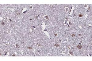 ABIN6268712 at 1/100 staining Human brain cancer tissue by IHC-P. (Aquaporin 4 抗体  (Internal Region))