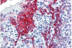 Human Tonsil (formalin-fixed, paraffin-embedded) stained with KRT13 antibody ABIN364278 at 10 ug/ml followed by biotinylated anti-mouse IgG secondary antibody ABIN481714, alkaline phosphatase-streptavidin and chromogen. (Cytokeratin 13 抗体)
