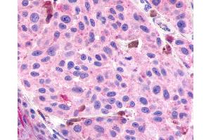 Anti-RXFP3 antibody IHC of human Skin, Melanoma. (Relaxin 3 Receptor 1 抗体  (Cytoplasmic Domain))