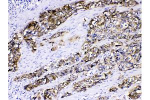 Cytokeratin 5 was detected in paraffin-embedded sections of human oesophagus squama cancer tissues using rabbit anti- Cytokeratin 5 Antigen Affinity purified polyclonal antibody (Catalog # ) at 1 µg/mL. (Cytokeratin 5 抗体  (Middle Region))