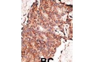 Formalin-fixed and paraffin-embedded human cancer tissue reacted with the primary antibody, which was peroxidase-conjugated to the secondary antibody, followed by AEC staining. (BMP1 抗体  (C-Term))