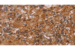 Immunohistochemistry of paraffin-embedded Human ovarian cancer tissue using JAKMIP2 Polyclonal Antibody at dilution 1:40 (JAKMIP2 抗体)