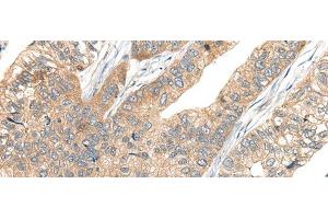 Immunohistochemistry of paraffin-embedded Human gastric cancer tissue using CA7 Polyclonal Antibody at dilution of 1:50(x200) (CA7 抗体)