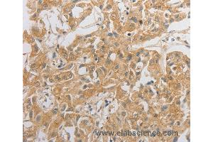 Immunohistochemistry of Human ovarian cancer using HCRTR2 Polyclonal Antibody at dilution of 1:50 (HCRTR2 抗体)