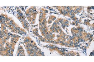 Immunohistochemistry of paraffin-embedded Human breast cancer tissue using CAMK4 Polyclonal Antibody at dilution 1:40 (CAMK4 抗体)