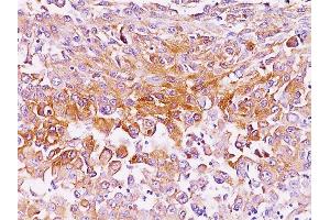 Formalin-fixed, paraffin-embedded human melanoma stained with gp100 / Melanosome Mouse Monoclonal Antibody (NKI-beteb). (Melanoma gp100 抗体)