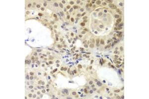 Immunohistochemistry of paraffin-embedded human oophoroma using MSH6 antibody at dilution of 1:100 (400x lens). (MSH6 抗体)
