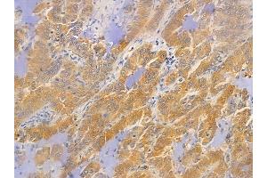 ABIN6255365 and ABIN6267475 at 1/100 staining human lung adenocarcinoma by IHC-P. (AKT2 抗体  (pSer474))