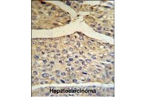 BF Antibody (Center) (R) IHC analysis in formalin fixed and paraffin embedded human hepatocarcinoma tissue followed by peroxidase conjugation of the secondary antibody and DAB staining. (Complement Factor B 抗体  (Center))