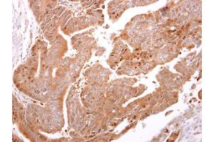 IHC-P Image ARF3 antibody detects ARF3 protein at cytosol on human colon carcinoma by immunohistochemical analysis. (ARF3 抗体)