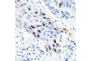 Immunohistochemistry of paraffin-embedded human lung cancer using Cyclin  Rabbit mAb (ABIN7266551) at dilution of 1:100 (40x lens). (Cyclin A 抗体)