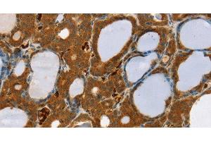 Immunohistochemistry of paraffin-embedded Human thyroid cancer using RAB27A Polyclonal Antibody at dilution of 1:30 (RAB27A 抗体)