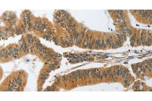 Immunohistochemistry of paraffin-embedded Human colon cancer tissue using PIK3R3 Polyclonal Antibody at dilution 1:45 (PIK3R3 抗体)