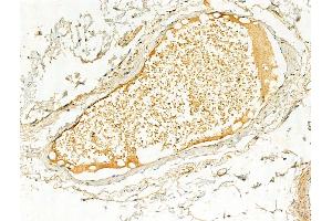 ABIN6256503 and ABIN6267060 at 1/100 staining Human normal tissues adjacent to colorectal cancer by IHC-P. (ERK1/2 抗体  (pThr202, pTyr204))