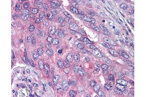 Anti-PLK1 antibody IHC of human lung carcinoma. (PLK1 抗体  (pThr210))