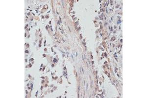 Immunohistochemistry of paraffin-embedded human lung cancer using NCO antibody  at dilution of 1:100 (40x lens). (NCOA4 抗体  (AA 495-614))