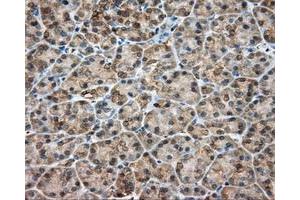 Immunohistochemical staining of paraffin-embedded Adenocarcinoma of colon tissue using anti-RDH11 mouse monoclonal antibody. (RDH11 抗体)