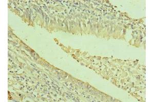 Immunohistochemistry of paraffin-embedded human lung cancer using ABIN7171996 at dilution of 1:100