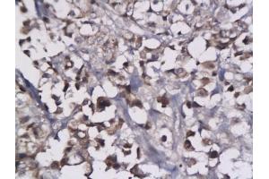 Formalin-fixed and paraffin embedded human breast cancer tissue labeled with Anti-LYVE-1 Polyclonal Antibody, Unconjugated (ABIN674799) followed by conjugation to the secondary antibody and DAB staining (LYVE1 抗体  (AA 231-318))