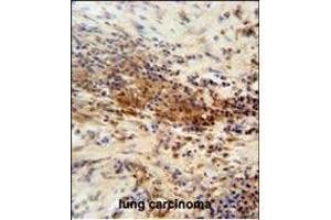 DNAJC11 antibody (N-term) (ABIN654437 and ABIN2844172) immunohistochemistry analysis in formalin fixed and paraffin embedded human lung carcinoma followed by peroxidase conjugation of the secondary antibody and DAB staining. (DNAJC11 抗体  (N-Term))
