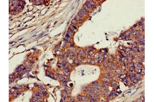 Immunohistochemistry of paraffin-embedded human colon cancer using ABIN7147600 at dilution of 1:100 (CH25H 抗体  (AA 142-272))