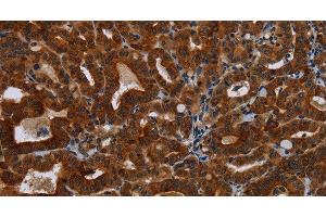 Immunohistochemistry of paraffin-embedded Human thyroid cancer tissue using KLHL1 Polyclonal Antibody at dilution 1:30 (KLHL1 抗体)