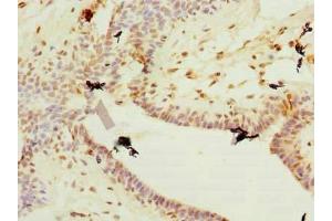 Immunohistochemistry of paraffin-embedded human breast cancer using ABIN7177750 at dilution of 1:100