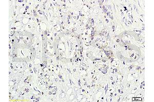 Formalin-fixed and paraffin-embedded human cervical carcinoma labeled with Rabbit Anti-CD160/By55 Polyclonal Antibody (ABIN741555), Unconjugated at 1:200 followed by conjugation to the secondary antibody and DAB staining. (CD160 抗体  (AA 81-159))