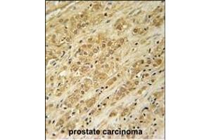 DKC1 Antibody (Center) (ABIN651670 and ABIN2840353) immunohistochemistry analysis in formalin fixed and paraffin embedded human prostate carcinoma followed by peroxidase conjugation of the secondary antibody and DAB staining. (DKC1 抗体  (AA 185-213))