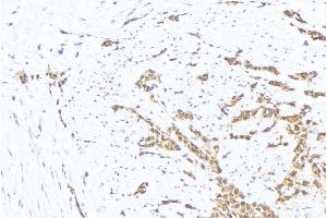 ABIN6276330 at 1/100 staining Human lung cancer tissue by IHC-P. (MTM1 抗体  (C-Term))