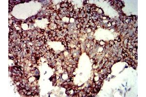 Immunohistochemical analysis of paraffin-embedded colon cancer tissues using P2RY14 mouse mAb with DAB staining. (P2RY14 抗体)