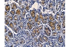 SPNS1 Antibody at 1/100 staining human pancreatic cancer and adjacent non-tumor tissue by IHC-P. (SPNS1/Spinster 1 抗体)