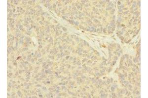 Immunohistochemistry of paraffin-embedded human ovarian cancer using ABIN7161035 at dilution of 1:100 (NANOS2 抗体  (AA 1-138))