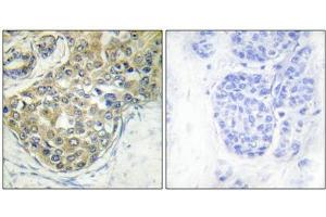 Immunohistochemical analysis of paraffin-embedded human breast carcinoma tissue using ACK1 (Phospho-Tyr284) antibody (left)or the same antibody preincubated with blocking peptide (right). (TNK2 抗体  (pTyr284))
