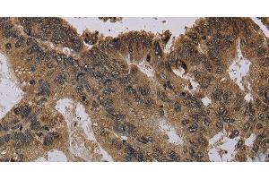 Immunohistochemistry of paraffin-embedded Human colon cancer using Histone H4 Polyclonal Antibody at dilution of 1:30 (Histone H4 抗体)