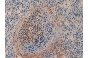 Detection of CD26 in Human Skin cancer Tissue using Polyclonal Antibody to Cluster Of Differentiation 26 (CD26)