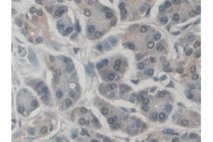 Detection of CD300c in Human Pancreatic cancer Tissue using Polyclonal Antibody to CD300 Antigen Like Family Member C (CD300c)