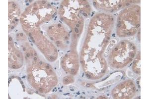DAB staining on IHC-P; Samples: Human Glioma Tissue (Interferon gamma 抗体  (AA 24-166))