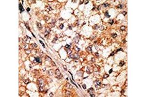 IHC analysis of FFPE human hepatocarcinoma tissue stained with the Bim antibody (BIM 抗体  (AA 130-165))