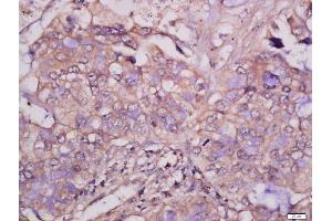 Formalin-fixed and paraffin embedded human lung carcinoma tissue labeled with Anti-MCSF Polyclonal Antibody, Unconjugated 1:400 followed by conjugation to the secondary antibody and DAB staining. (M-CSF/CSF1 抗体  (AA 201-300))