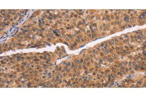 Immunohistochemistry of paraffin-embedded Human liver cancer tissue using NCAPG2 Polyclonal Antibody at dilution 1:50 (NCAPG2 抗体)